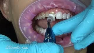 Prepless upper and lower Porcelain Dental Veneers