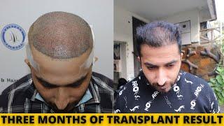 My Hair Transplant result after 3 months | Born Creator