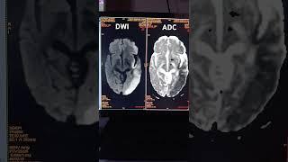 Acute infarct   #anatomy #beginners #like #subscribe #mri #mritech #brain #doctor