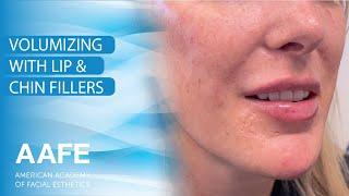 Volumizing with Lip & Chin Fillers