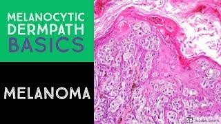 Melanocytic Dermpath Basics: Melanoma