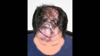 6,500 FUT Grafts- Repair of Old Hair Transplant- Feller and Bloxham