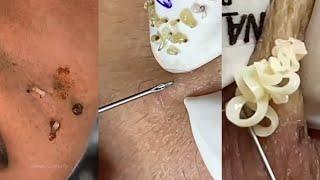 Intense Blackhead Extraction: Deep Clean Your Skin!