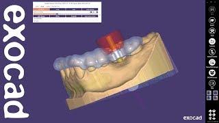 exocad Quick Guide: Get most out of guided surgery