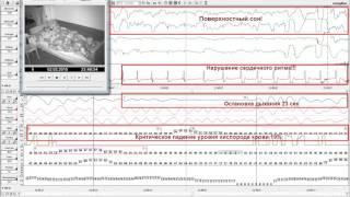 Как выглядит полисомнография ? УкрТелеМед Лаборатория сна