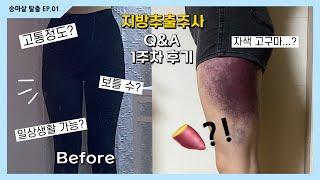 [ 지방추출주사1주차 ] 람스 Q&A | 자색고구마 멍 | 시술 고통 | 지흡 차이점 | 보틀 수 | 일상생활 가능? | 지방추출주사 당일 | 승마 허안 지흡주사