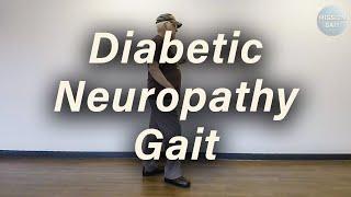 Diabetic Neuropathy Gait