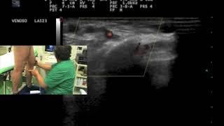 Outward contractive flow in a calf perforator and leg varicose veins