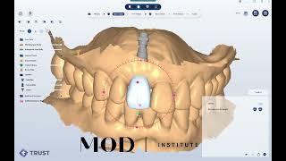 Possibly the most powerful software combination in digital dentistry is completely free!