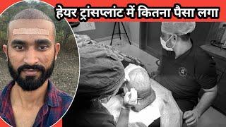 हेयर ट्रांसप्लांट मैं कितना पैसा लगता है  hair transplant cost #supersharmajivlog