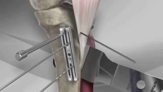 Tibial Tubercle Osteotomy with Arthrex® T3 AMZ System