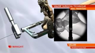 VALOR™ Hindfoot Fusion Nail System Animation