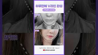 처진 얼굴을 올려주는 실리프팅
