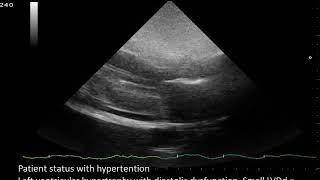 CASE 678 ECHO Left ventricular hypertrophy with diastolic dysfunction Small LVDd  Mild pericardial e