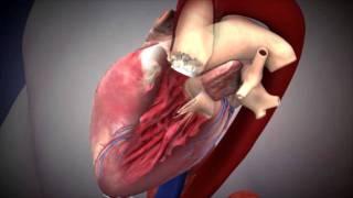 NUHCS - Transcatheter Aortic Valve Implantation (TAVI)