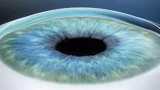 LASIK Eye Surgery Houston - SuraVision