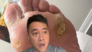 Shocking Diabetic Foot Ulcer  Dead Skin Removed Just in Time! | Healthy Feet Podiatry