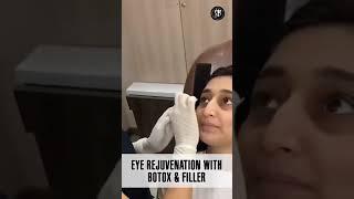 Eye rejuvenation with Botox & Fillers Treatment! #botox #fillers #shorts #shortvideo #youtubeshorts