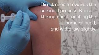 Injection Technique into the Glenohumeral Joint for OA or Adhesive Capsulitis