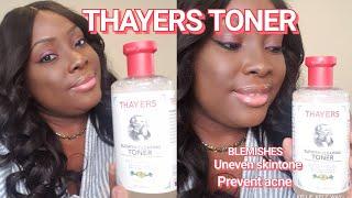 THAYERS FACIAL TONER | NO MORE BLEMISHES | KELLIE KELZ WAY