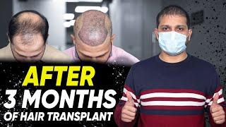 Hair Transplant in Ahmedabad | Best Results & Cost of Hair Transplant in Ahmedabad