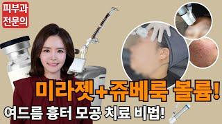 (ENG/JP) 미라젯 쥬베룩볼륨  여드름흉터 모공 치료 효과가 궁금하신가요?