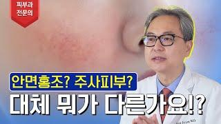 일반 홍조인 줄 알았는데 주사피부라고요? | 주사피부(Rosacea)에 모든 것!