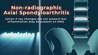 Welcome to the National Axial Spondyloarthrititis Society