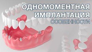 Одномоментная имплантация зубов. Какие особенности одномоментного протезирования?