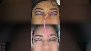 Blepharoplasty Surgery | Eyelid Surgery Treatment  | #SaggingSkin