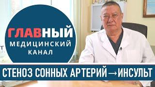 Стеноз сонной артерии: симптомы и лечение стеноза. Атеросклеротический стеноз сонных артерий