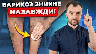 Як позбутися варикозу БЕЗ ОПЕРАЦІЇ? Справжні причини судинної сітки та варикозу!