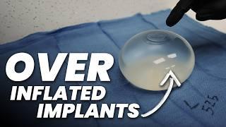 Over-Filled Breast Implants: What can happen?! 