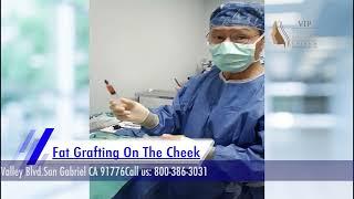 Fat Grafting On The Cheek  Plastic Vipsurgery_Andrew Choi, M.D.- Certified Facial Plastic Surgeo