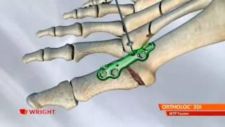 Wright - Ortholoc 3DI MTP Fusion   NEW