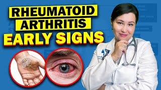 Early Warning Signs Of Rheumatoid Arthritis | Don't Ignore These Vital Symptoms!