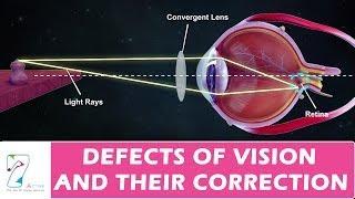 DEFECTS OF VISION AND THEIR CORRECTION