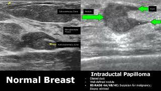 Breast Ultrasound Normal Vs Abnormal Image Appearances Comparison | BI-RADS Classification USG