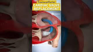 Cardiac Valve Replacement #medical #tech #science #doctor #heart