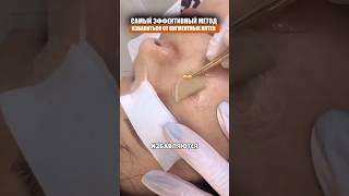 Быстрое удаление пигментных пятен
