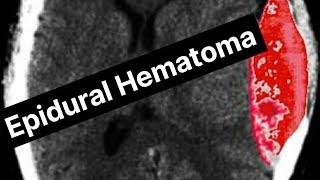 EpiduraHematoma \Dr Muhammad Ameer Hamza