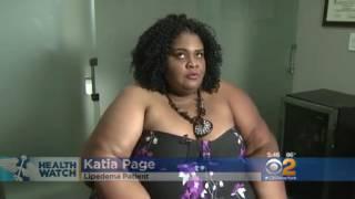 Lipedema Causes Woman's Legs To Expand: NYC Surgical Associates Provides New Treatment