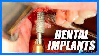 Dental Implants (SURGERY)