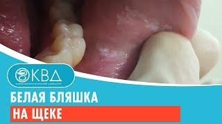  Белая бляшка на щеке. Клинический случай №940