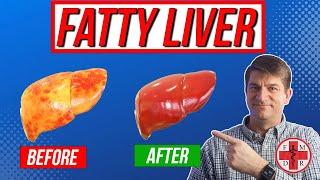 Fix Your Fatty Liver in 6 Simple Steps!