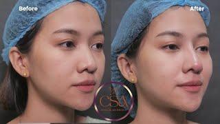 The CSA natural approach to Nonsurgical noselift | Dr. Contessa Salvador-Alapag