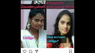 #venpulli #vitiligo 100% success Vitiligo Treatment Live result| How to vitiligo treatment in tamil