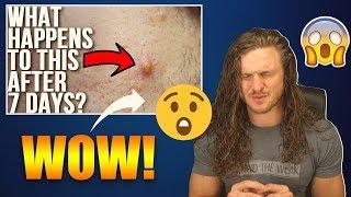 Don't Touch Your Acne & See What Happens | REACTION