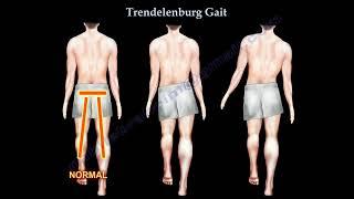 Trendelenburg Gait: Causes, Symptoms, and Role of the Gluteus Medius