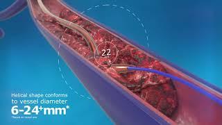 ClotHunter™ paired with ZelanteDVT™ Thrombectomy Catheter Enhancement